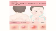 【健康科普】打响水痘“防御战”：守护健康秘籍大揭秘！